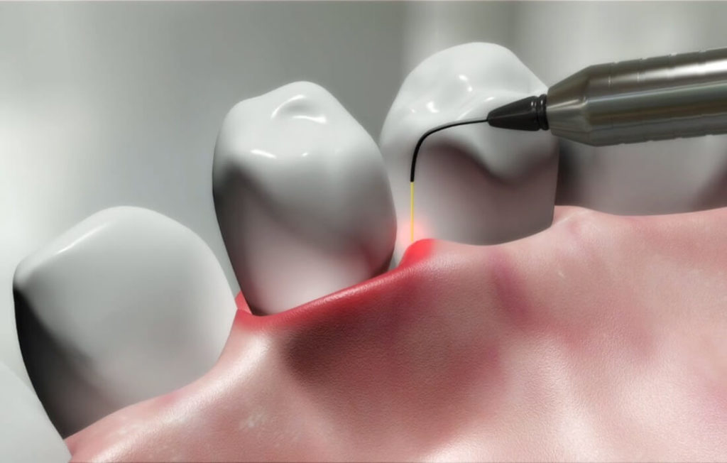 Laserterapia Odontologia e Harmonização Facial em Curitiba