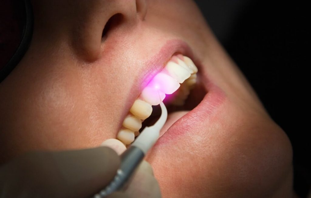 Laserterapia Odontologia e Harmonização Facial em Curitiba