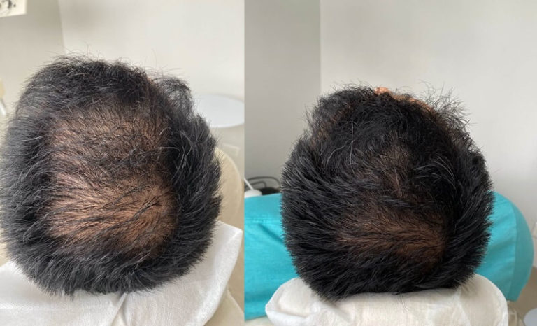 Ozonioterapia para tratamento de queda de cabelo em Curitiba