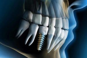 Implante Dentário unitário em Curitiba