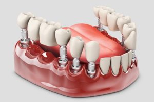 Implante Dentário parcial Clínica de Ortodontia