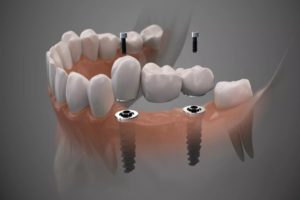 Implante Dentário parcial